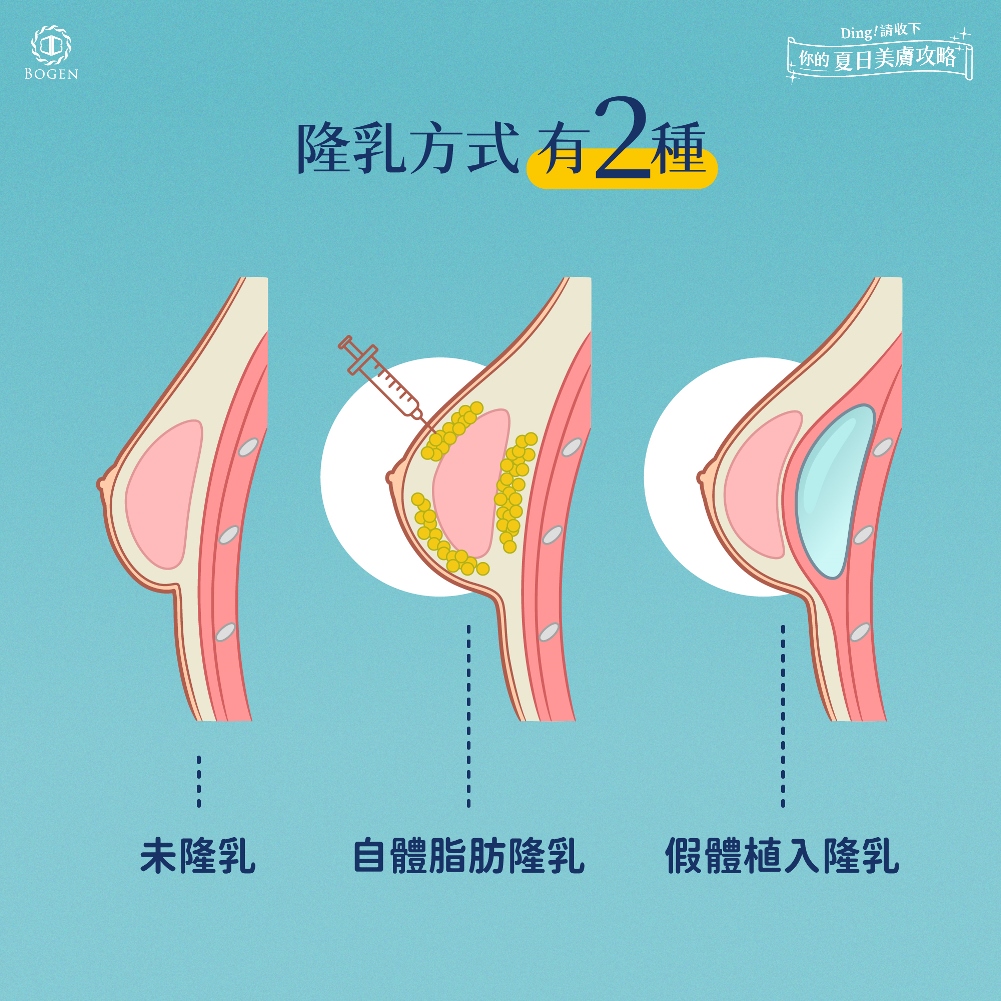 隆乳手術方式分兩種：假體植入與自體脂肪移植